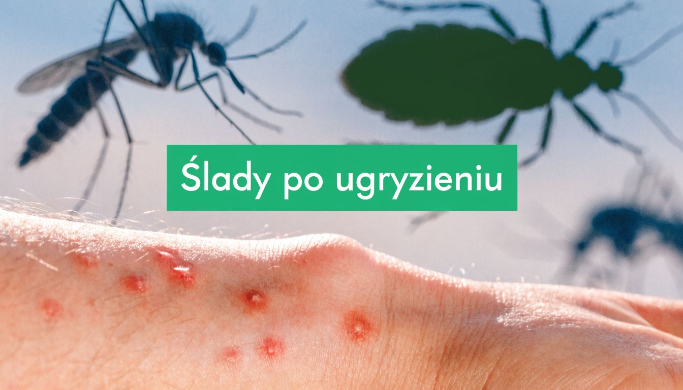 Ślady po ugryzieniu: Kto gryzie? Rozpoznaj i działaj